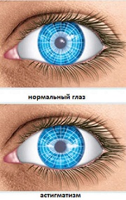 Нормальное зрение и глаза при обратном типе астигматизма